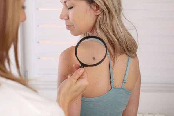 What Are Traditional Skin Lesion Removal Methods Swanage?