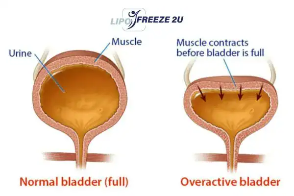 diagram of overactive bladder treatment Swanage