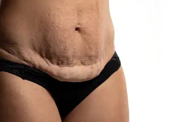 loose skin after weight loss injections Swanage
