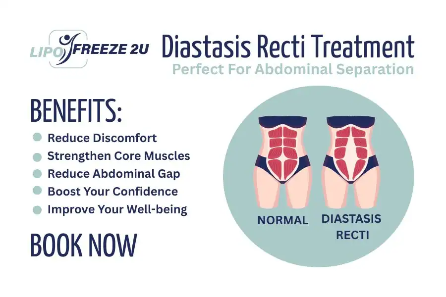 How Long Will It Take to See Improvements in Diastasis Recti Swanage