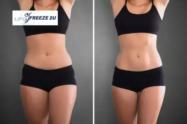 How Can LIPO FREEZE 2U Support Your Post-Pregnancy Body Recovery Swanage?