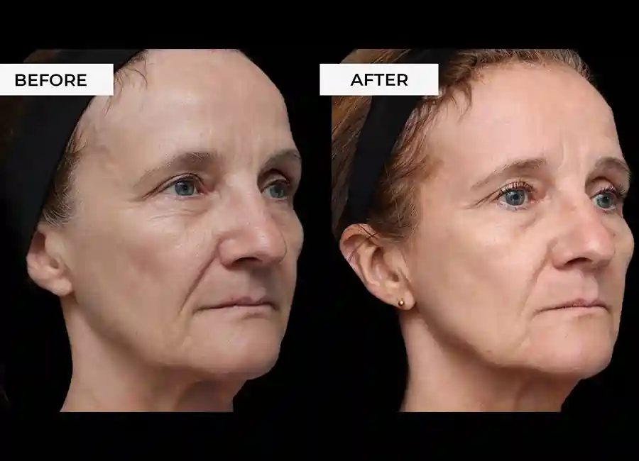How Many RF Microneedling Sessions Will You Need to See a Difference Swanage?