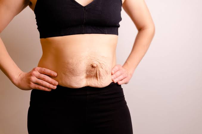Is Surgery Really the Only Way to Repair Diastasis Recti Swanage?