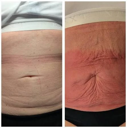 How Does RF Microneedling Improve Crepey, Thin and Uneven Skin Texture Swanage?