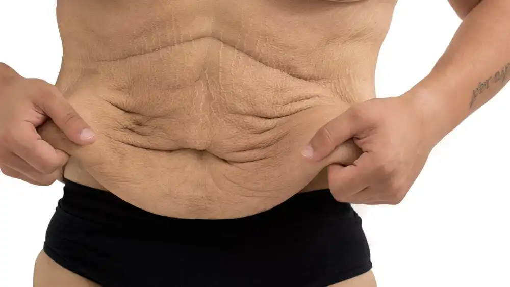 Why Does Weight Loss Medication Leave Some People With Loose or Sagging Skin Swanage?